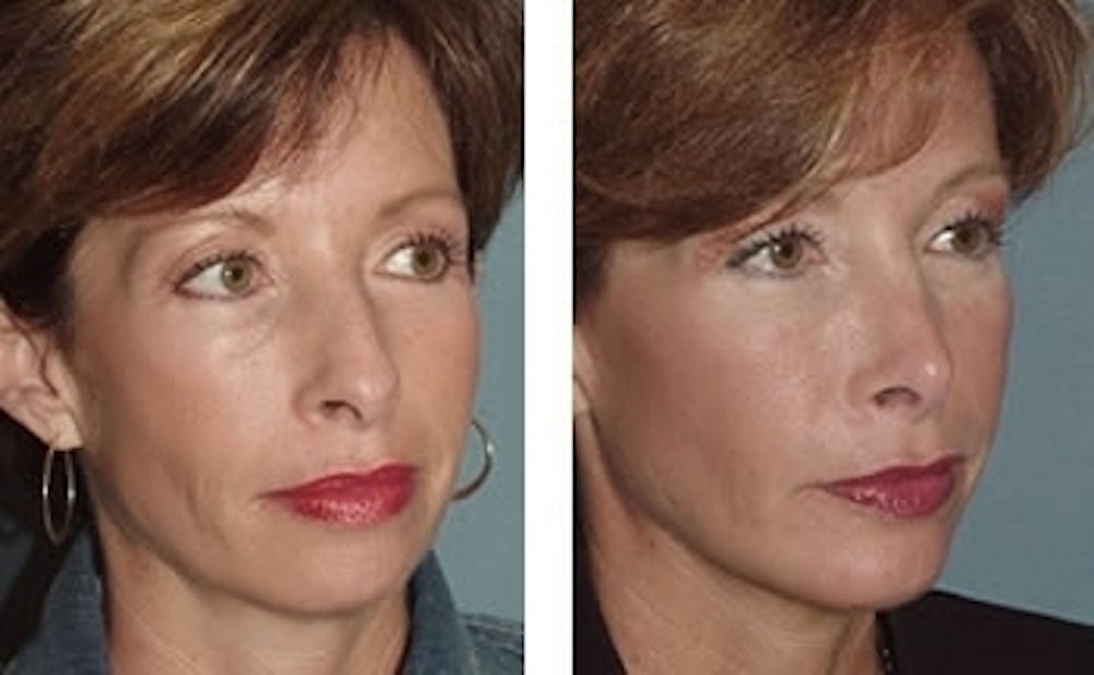 Rhinoplasty <span class=small>By Dr. Daniel Rousso</span> Before & After Gallery - Patient 1993315 - Image 2