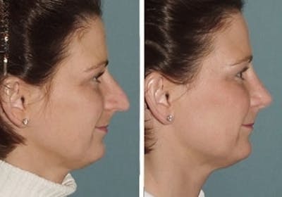 Rhinoplasty Before & After Gallery - Patient 1993317 - Image 1