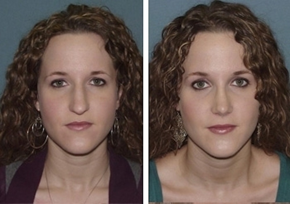 Rhinoplasty Before & After Gallery - Patient 1993318 - Image 2