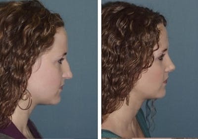 Rhinoplasty Before & After Gallery - Patient 1993318 - Image 1