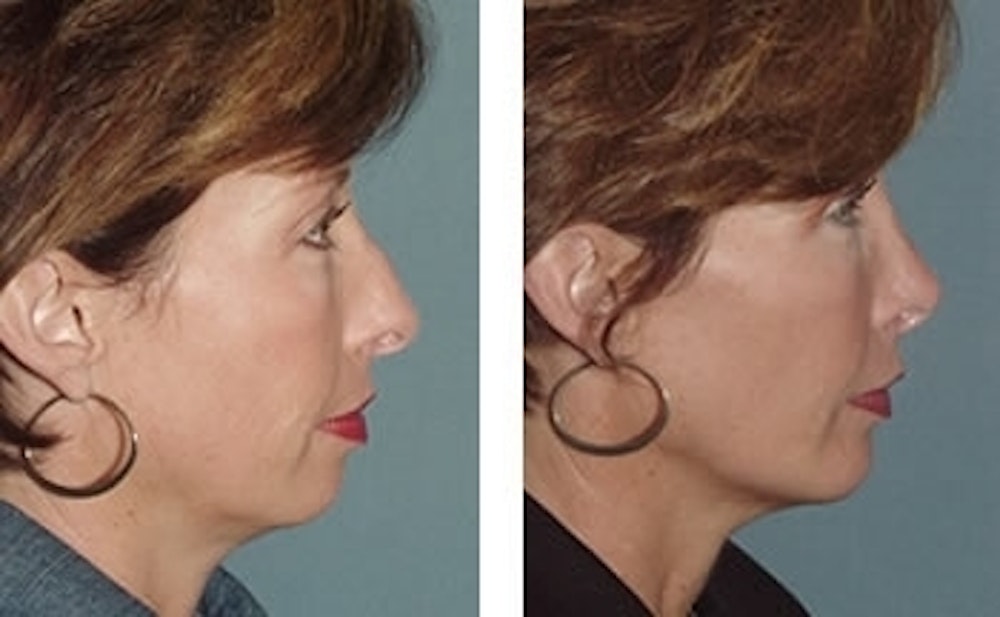 Rhinoplasty Before & After Gallery - Patient 1993315 - Image 1
