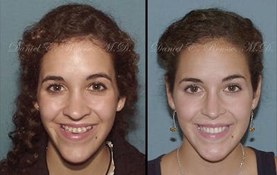 Rhinoplasty Before & After Gallery - Patient 1993324 - Image 1