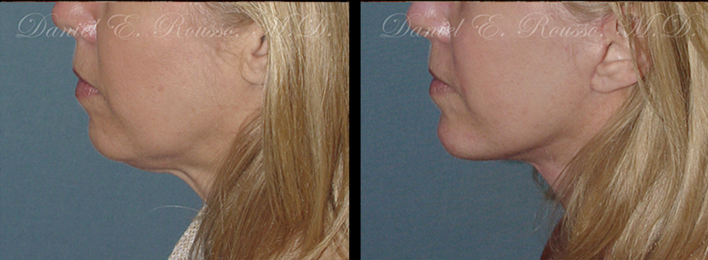 Facial Implants Before & After Gallery - Patient 147124257 - Image 1