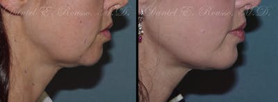 Facial Implants Before & After Gallery - Patient 147124258 - Image 1