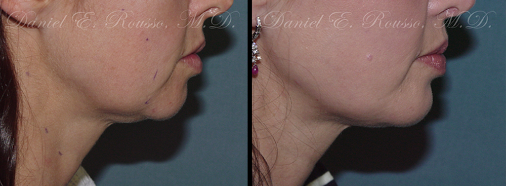 Facial Implants Before & After Gallery - Patient 147124258 - Image 1