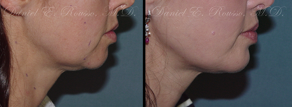 Facial Implants Before & After Gallery - Patient 1993370 - Image 1