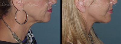Facial Implants Before & After Gallery - Patient 147124259 - Image 1