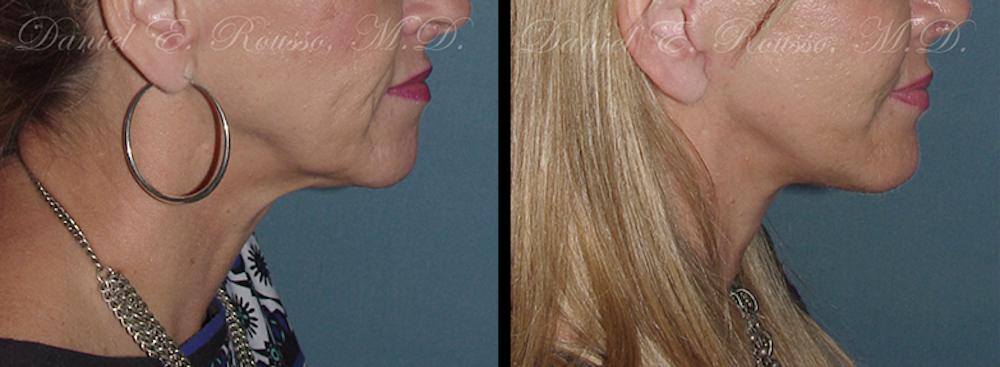 Facial Implants Before & After Gallery - Patient 147124259 - Image 1