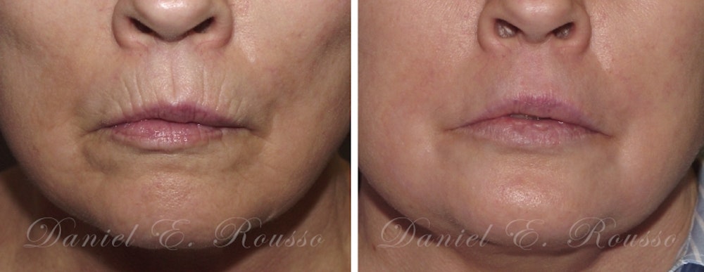 Deep Chemical Peel Gallery <span class=small>By Dr. Daniel Rousso</span> Before & After Gallery - Patient 1993372 - Image 1