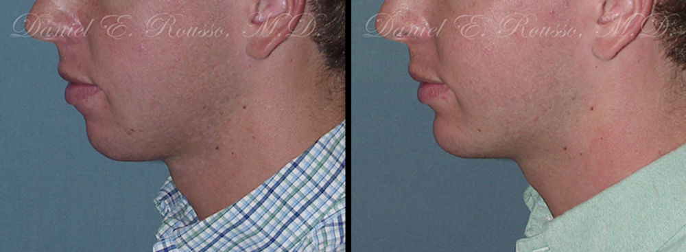 Facial Implants Before & After Gallery - Patient 1993374 - Image 1