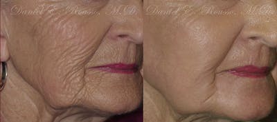 Deep Chemical Peel Before & After Gallery - Patient 1993376 - Image 1