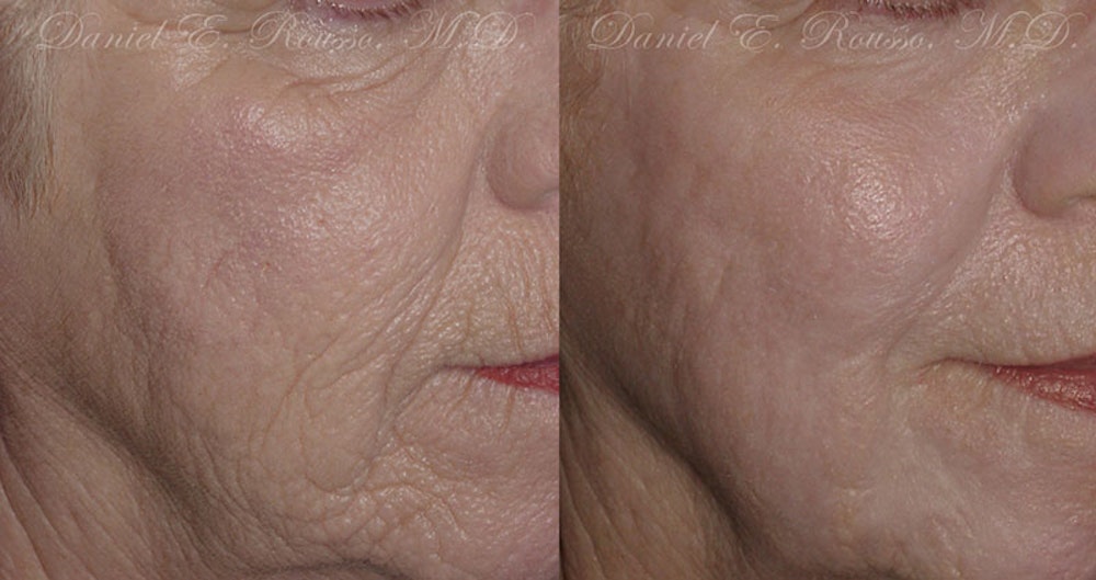 Deep Chemical Peel Before & After Gallery - Patient 1993377 - Image 1