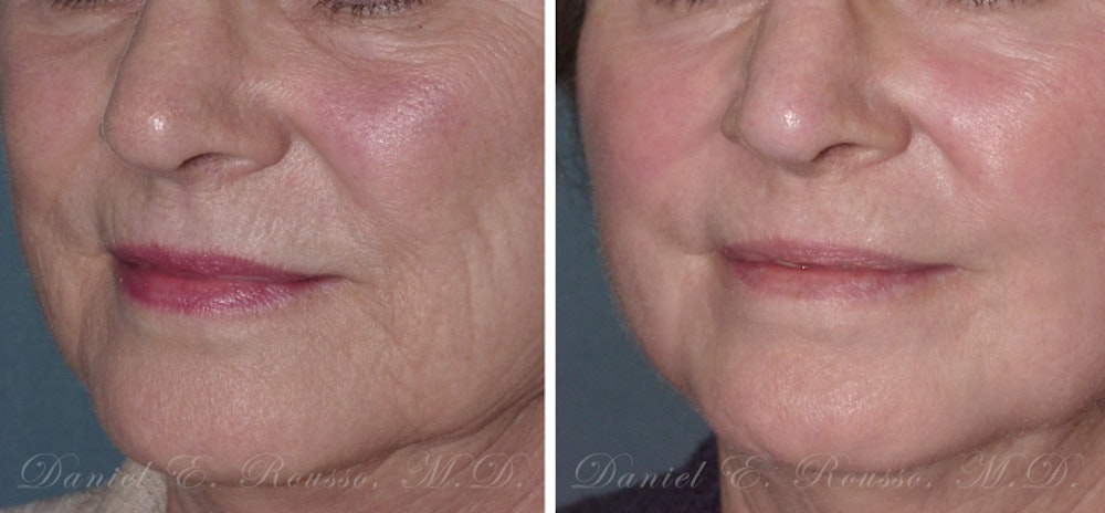 Deep Chemical Peel Before & After Gallery - Patient 147124252 - Image 1