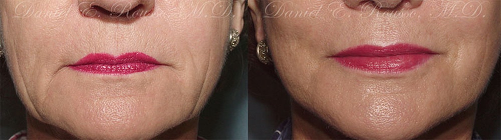 Lip Enhancement Before & After Gallery - Patient 1993379 - Image 1