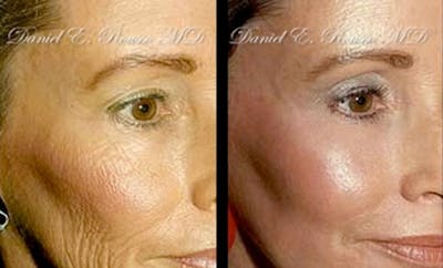 Deep Chemical Peel Before & After Gallery - Patient 1993380 - Image 1