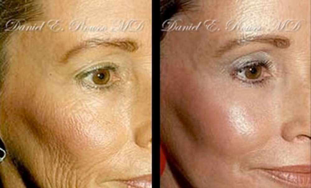 Deep Chemical Peel Before & After Gallery - Patient 147124253 - Image 1
