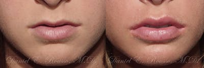 Lip Enhancement Before & After Gallery - Patient 1993381 - Image 1