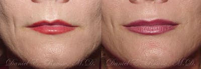 Lip Enhancement Before & After Gallery - Patient 1993383 - Image 1