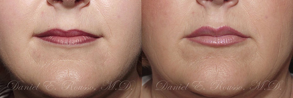 Lip Enhancement Before & After Gallery - Patient 1993384 - Image 1