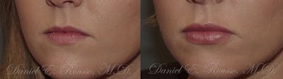 Lip Enhancement Before & After Gallery - Patient 1993385 - Image 1