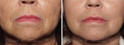 Skin Rejuvenation Before & After Gallery - Patient 147124272 - Image 1