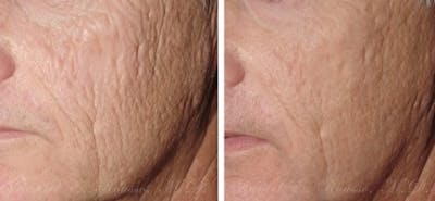 Skin Rejuvenation Before & After Gallery - Patient 1993389 - Image 1