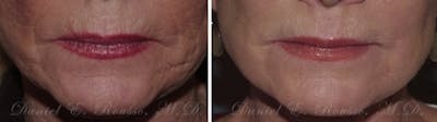 Skin Rejuvenation Before & After Gallery - Patient 1993390 - Image 2