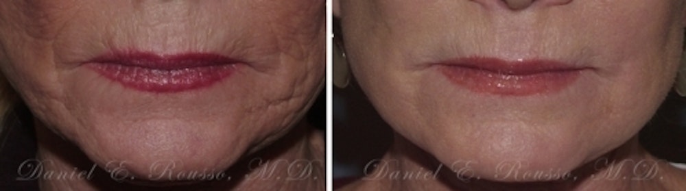 Skin Rejuvenation Before & After Gallery - Patient 1993390 - Image 2