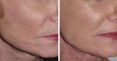 Skin Rejuvenation Before & After Gallery - Patient 147124274 - Image 1