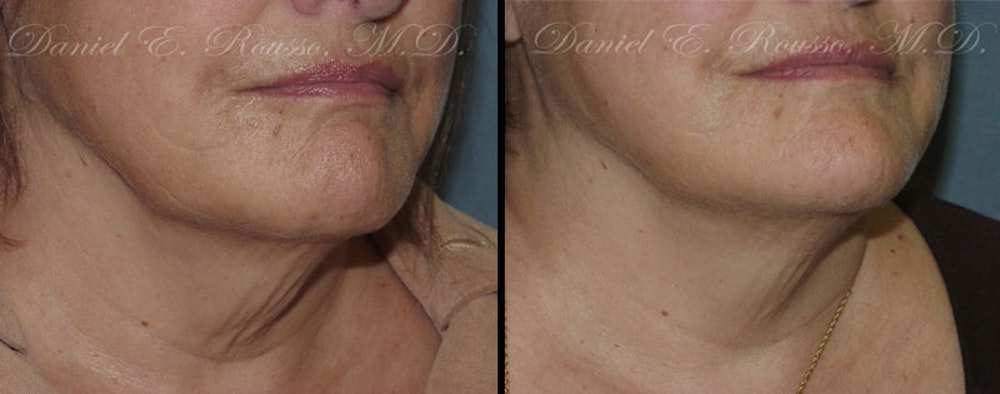 Ultherapy Before & After Gallery - Patient 1993392 - Image 2