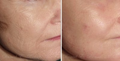 Skin Rejuvenation Before & After Gallery - Patient 1993393 - Image 1