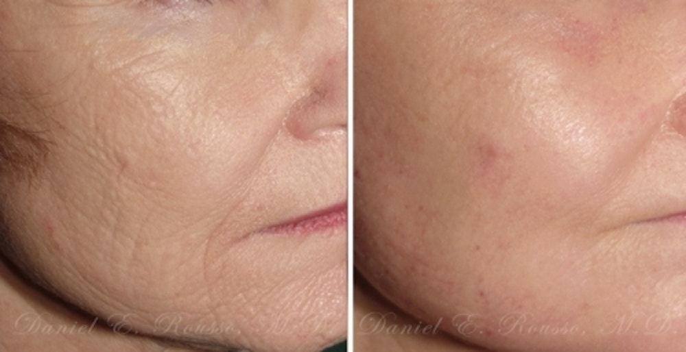Skin Rejuvenation Before & After Gallery - Patient 1993393 - Image 1