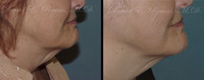 Ultherapy Before & After Gallery - Patient 1993392 - Image 1
