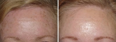 Skin Rejuvenation Before & After Gallery - Patient 1993395 - Image 1