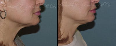 Ultherapy Before & After Gallery - Patient 1993396 - Image 1