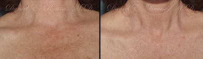 Skin Rejuvenation Before & After Gallery - Patient 1993397 - Image 1