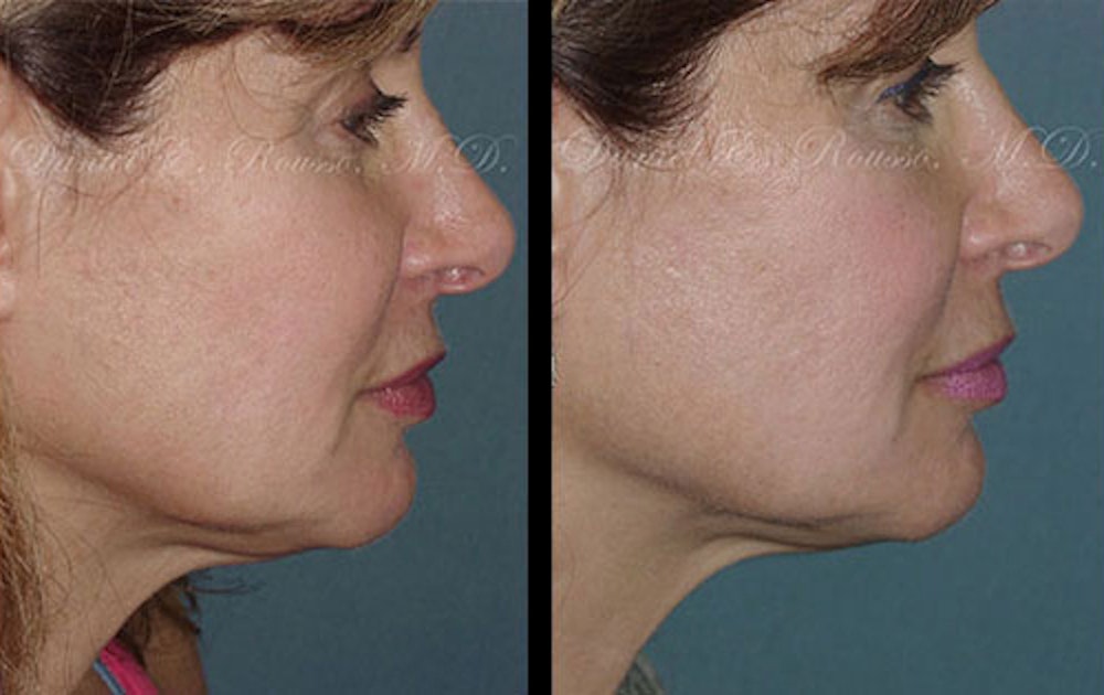 Ultherapy Before & After Gallery - Patient 1993399 - Image 1