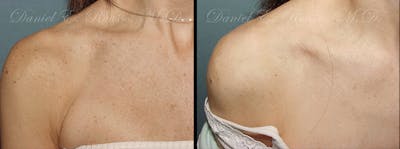 Skin Rejuvenation Before & After Gallery - Patient 1993400 - Image 1
