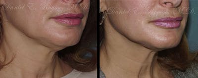 Ultherapy Before & After Gallery - Patient 1993399 - Image 2
