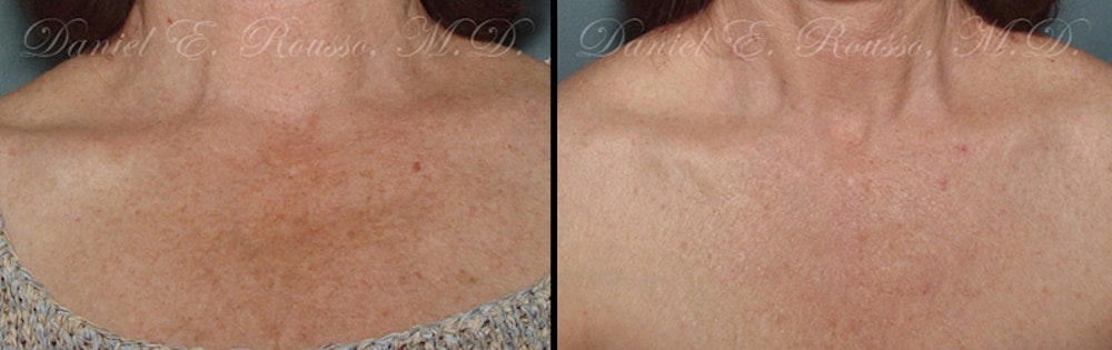 Skin Rejuvenation Before & After Gallery - Patient 1993402 - Image 1