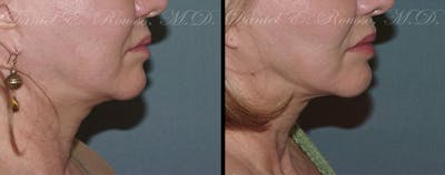 Ultherapy Before & After Gallery - Patient 1993403 - Image 1