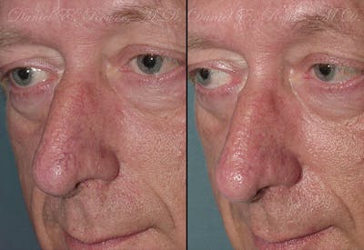 Skin Rejuvenation Before & After Gallery - Patient 1993405 - Image 1