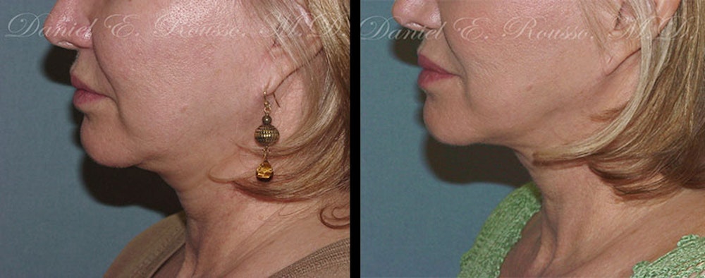 Ultherapy Before & After Gallery - Patient 1993403 - Image 2