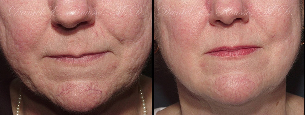 Skin Rejuvenation Before & After Gallery - Patient 147124281 - Image 1