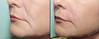 Fillers Before & After Gallery - Patient 1993428 - Image 1