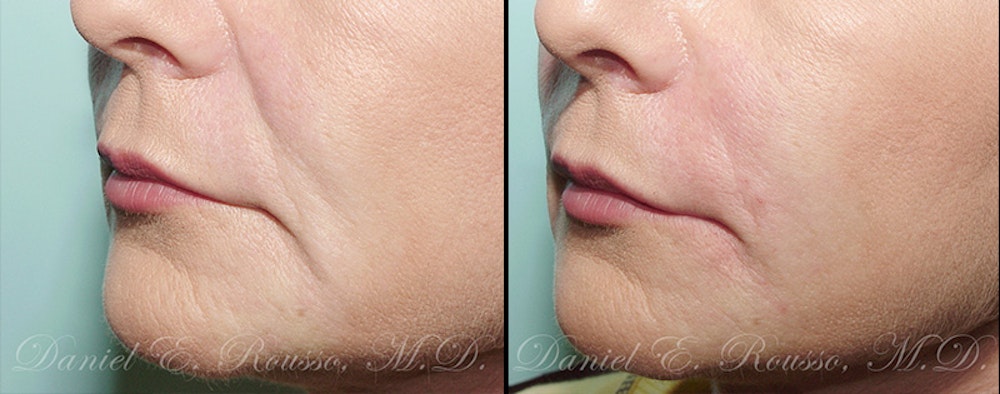Fillers Before & After Gallery - Patient 1993428 - Image 1
