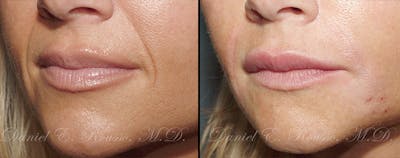 Fillers Before & After Gallery - Patient 1993430 - Image 1