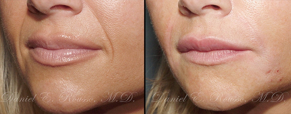 Fillers Before & After Gallery - Patient 1993430 - Image 1