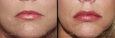 Fillers Before & After Gallery - Patient 1993433 - Image 1