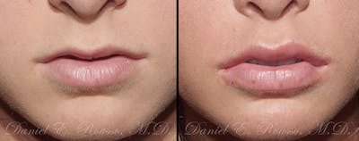 Fillers Before & After Gallery - Patient 1993434 - Image 1